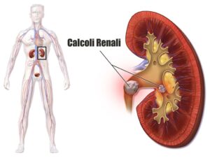 Cosa sono i calcoli renali e come curarli